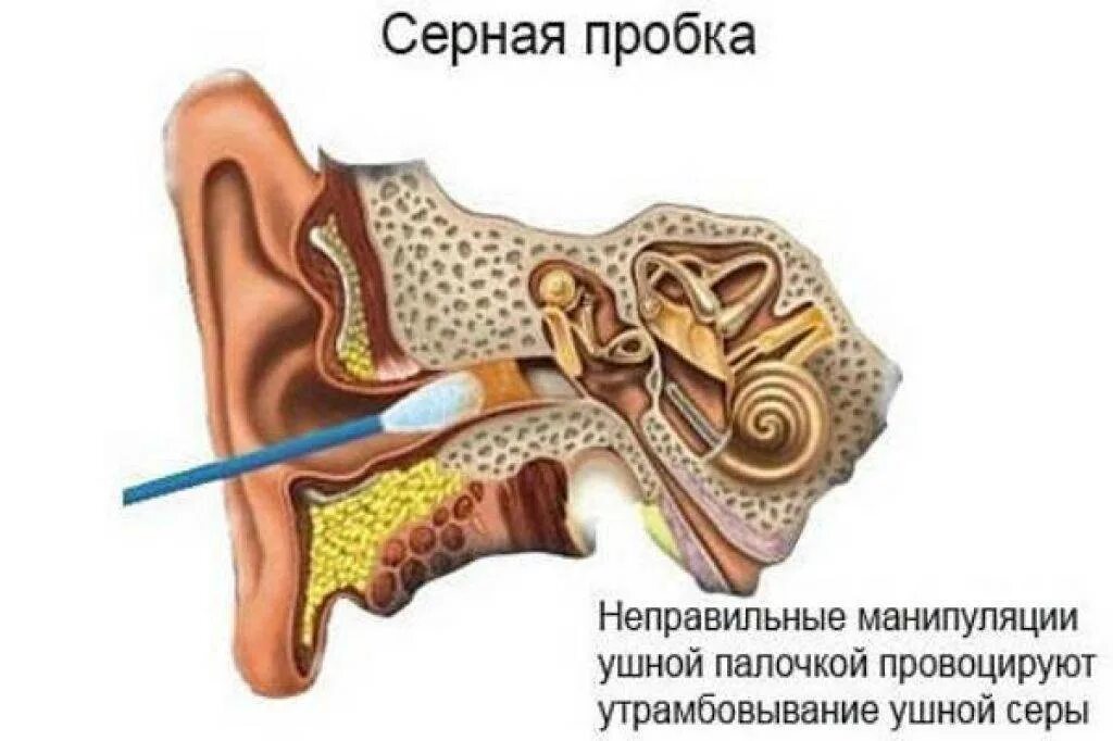 Как убрать заложенное ухо. Строение уха ушная пробка. Серная пробка на барабанной перепонке. Внутреннее ухо серная пробка. Ушная сера в барабанной перепонке.