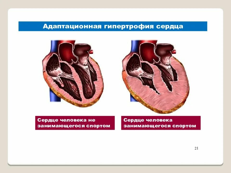 Сердце человека и спортсмена. Гипертрофия миокарда у спортсменов. Спортивная гипертрофия сердца. Сердце тренированного и нетренированного человека.