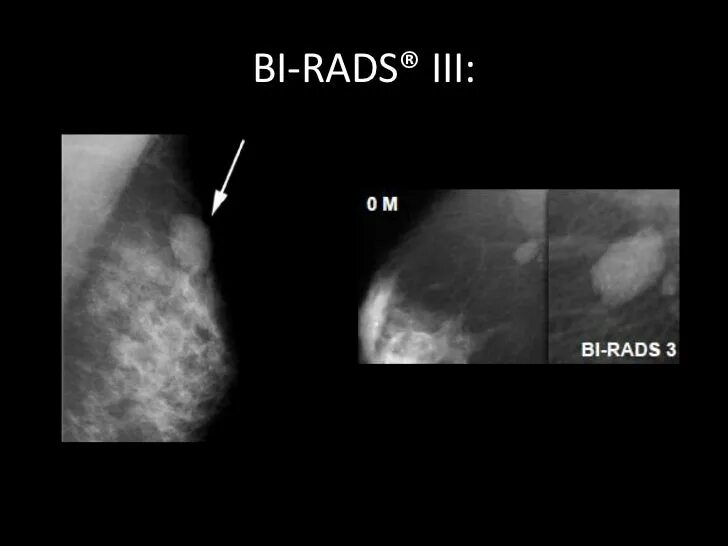 Маммография классификация bi-rads. Фиброзно кистозная мастопатия молочной железы bi-rads-4a. Классификация молочной железы bi rads. Bi-rads 3 молочной железы маммограмма. Категории маммографии