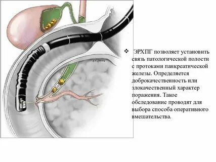 Конкременты в поджелудочной железе