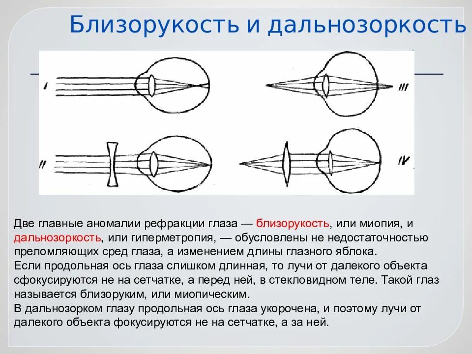 Недостатки дальнозоркости. Аномалии рефракции глаза близорукость дальнозоркость астигматизм. Аномалии рефракции глаза близорукость дальнозоркость таблица. Аномалии рефракции миопия гиперметропия астигматизм. Аномалии рефракции глаза корректируются с помощью линз.