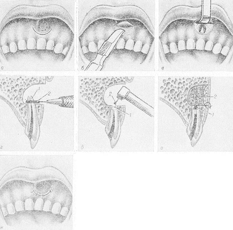 Переходная складка слизистой. Периодонтит резекция верхушки корня зуба. Операция резекция верхушки корня. Операция резекции верхушки корня зуба. Резекция верхушки зуба этапы операции.