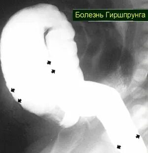 Симптом шума плеска при кишечной непроходимости