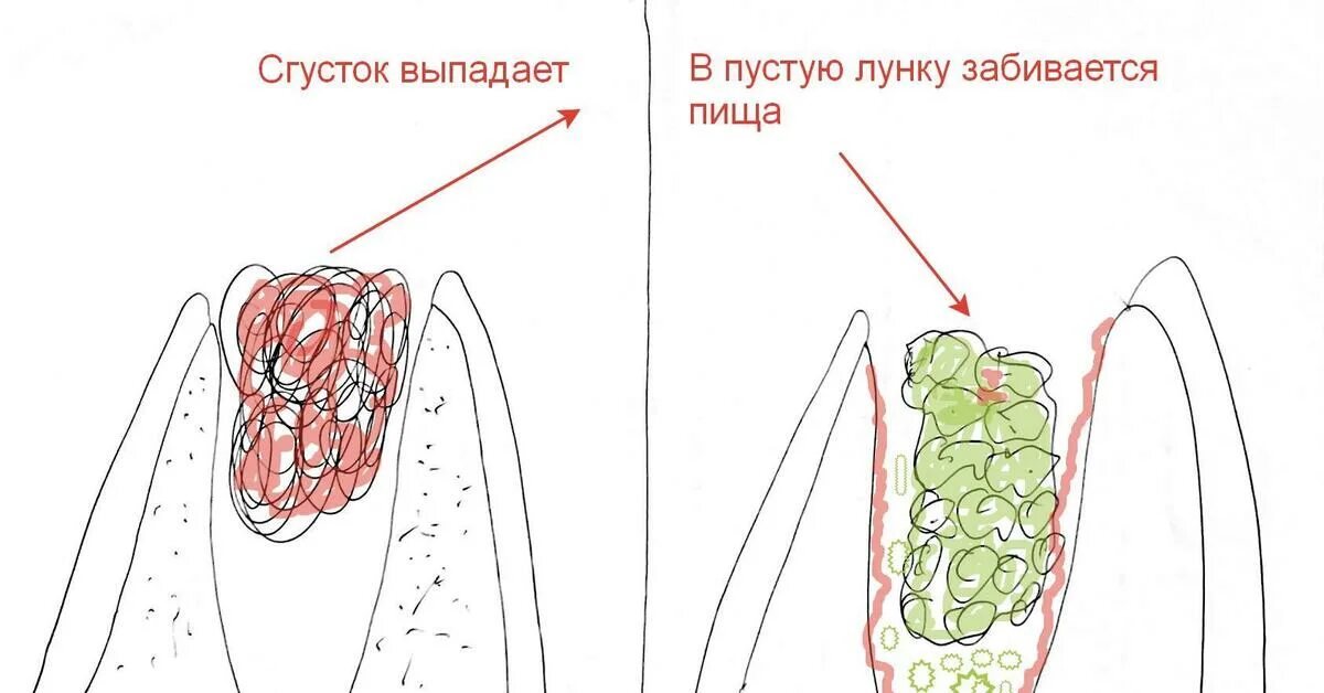 Как выглядит зажившая десна после удаления зуба Удаление зубов любой сложности -Хирургия -Услуги