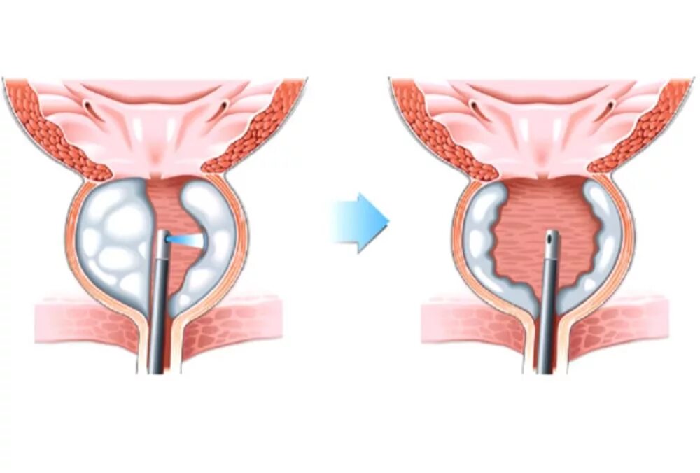 Как убрать простату. Трансуретральная лазерная энуклеация. Лазерная энуклеация предстательной железы. Лазерная энуклеация аденомы предстательной железы. Трансуретральная лазерная энуклеация аденомы предстательной железы.