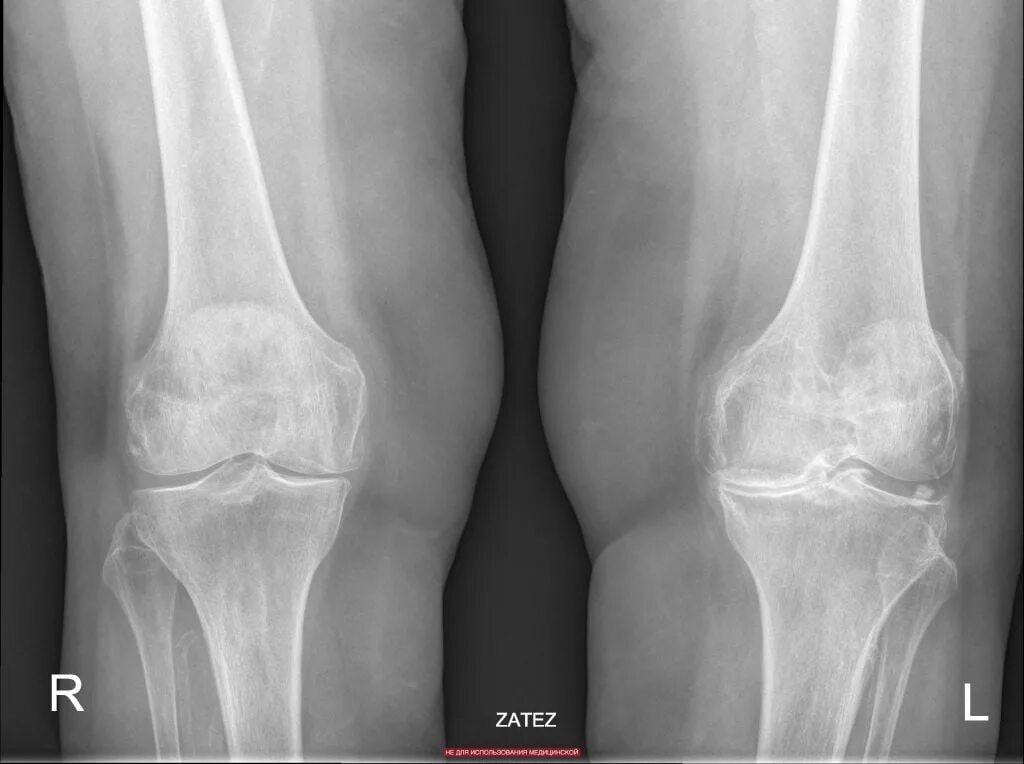 Остеоартроз 1 2 степени коленного сустава. Гонартроз коленного сустава рентген. Остеоартроз коленного сустава рентген. Деформирующий остеоартроз рентген. Гонартроз 2 степени коленного сустава рентген.