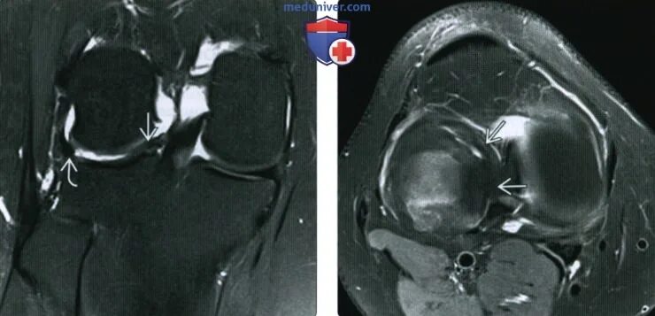 Разрыв мениска мрт. Разрыв мениска ручка лейки мрт. Разрыв мениска по типу ручки лейки мрт. Разрыв медиального мениска мрт.