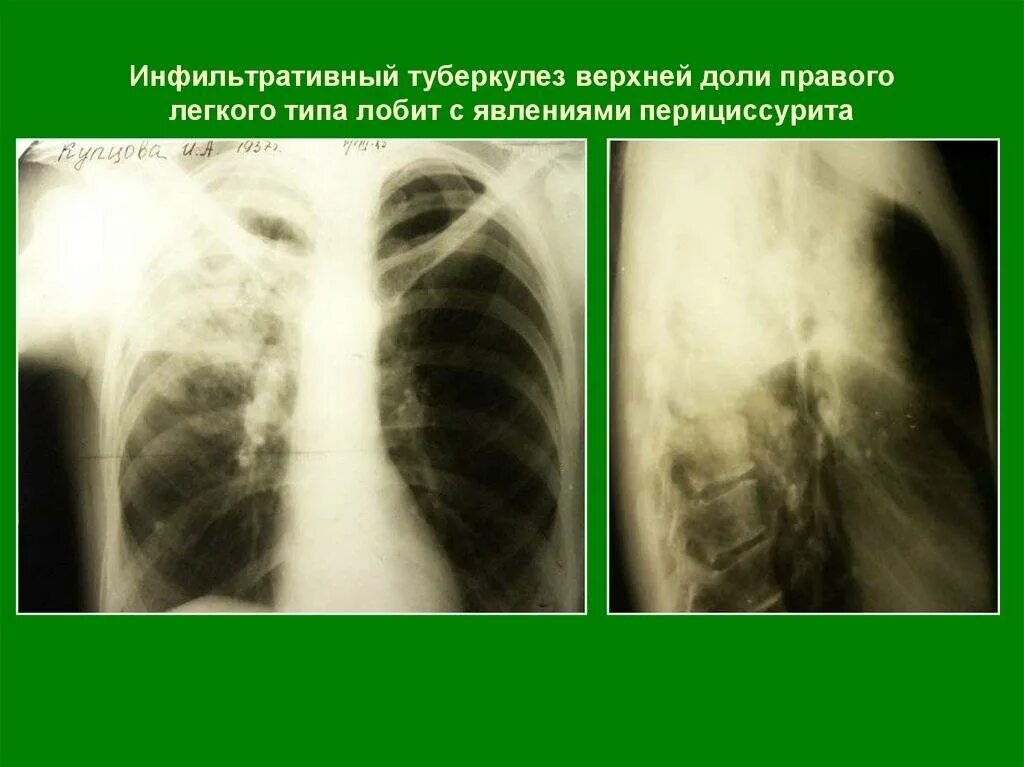 Инфильтрация является