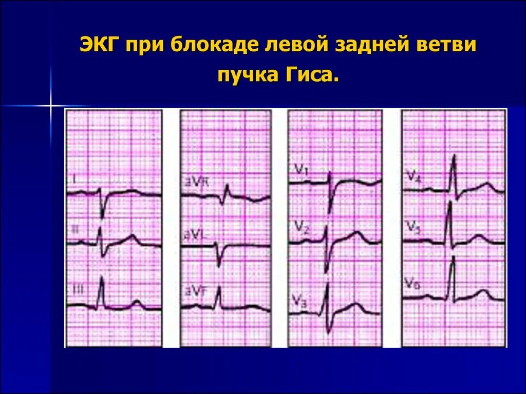 Блокада передне лнпг. Неполная блокада передней ветви ЛНПГ на ЭКГ. ЭКГ при блокаде задней ветви левой ножки пучка Гиса. Блокада левой ножки пучка Гиса на ЭКГ. ЭКГ при блокаде задней ветви левой ножки.