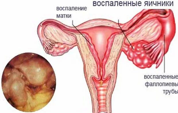 Как лечить левый яичник у женщины