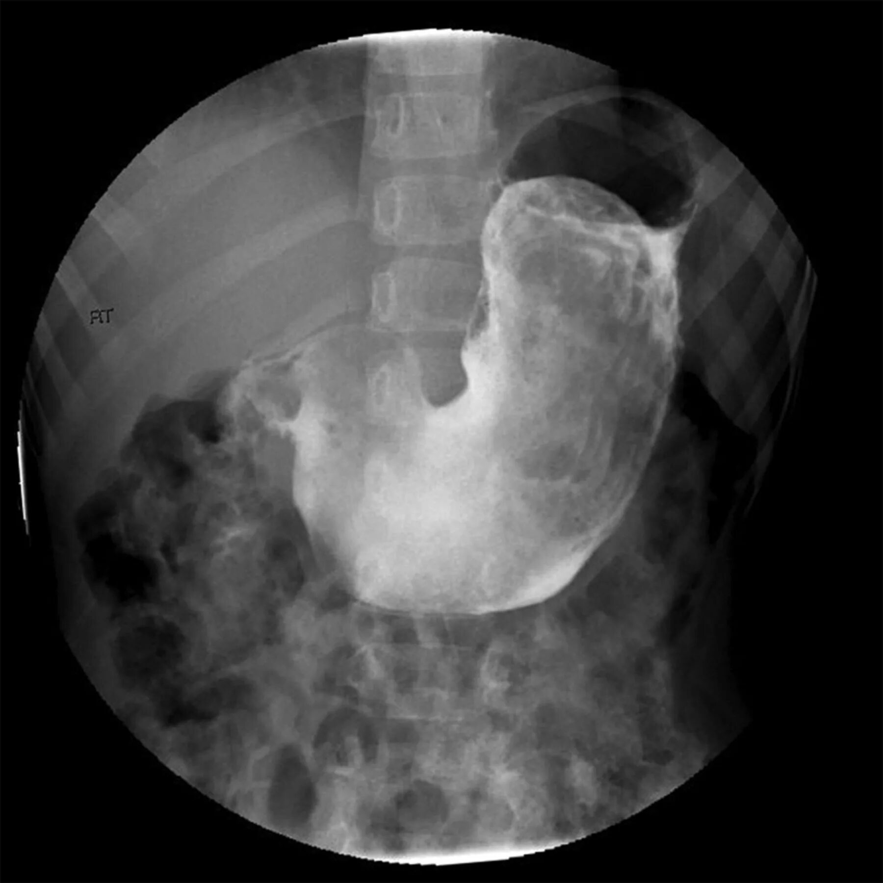 Синдром рапунцель симптомы. Извлекли волосы из желудка. Синдров рапунцель синдром. Синдром рапунцель симптомы. Рапунцель дзен.