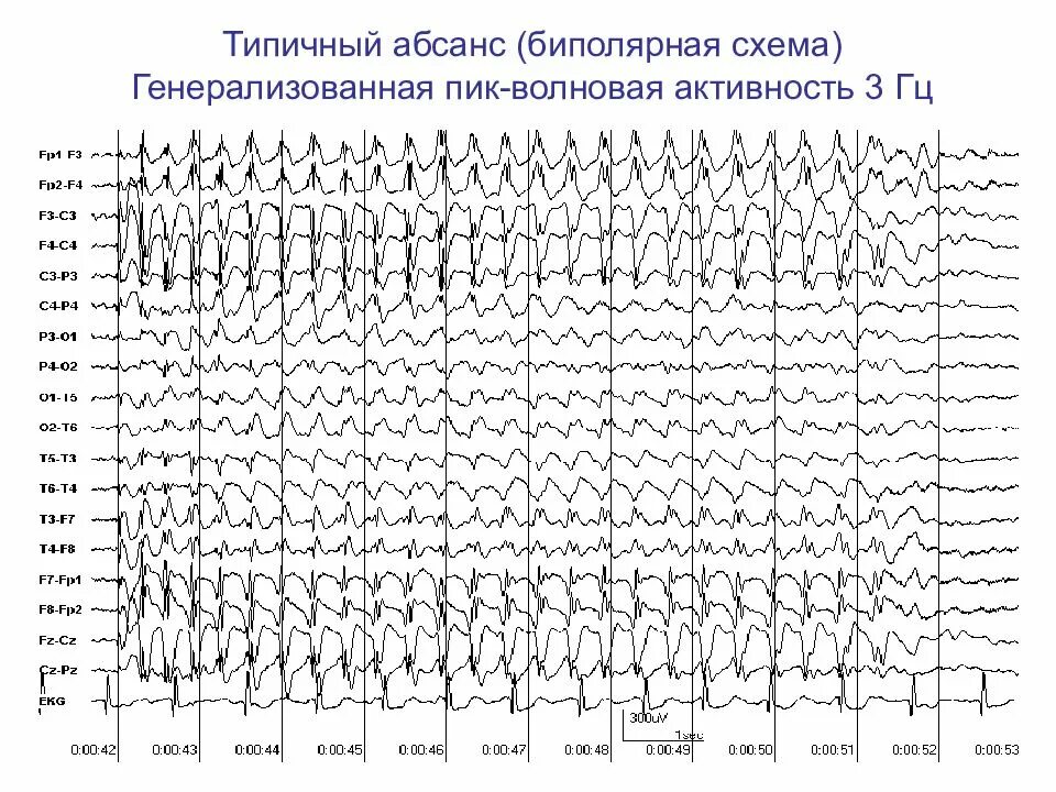 Пароксизмальная ээг. Абсансная эпилепсия на ЭЭГ. Паттерн абсанса на ЭЭГ. Генерализованная эпилептиформная активность на ЭЭГ У ребенка. Детская абсансная эпилепсия на ЭЭГ.