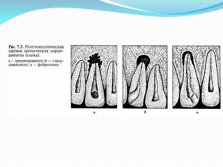 Фиброзный периодонтит. Апикальный периодонтит классификация. Фиброзный периодонтит рентген. Хронический апикальный периодонтит пульпарного происхождения. Острый периодонтит патологическая гистология.