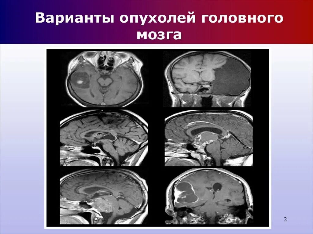 Объемное образование головного мозга. Новообразование в головном мозге. Злокачественное новообразование головного мозга. Есть рак головы