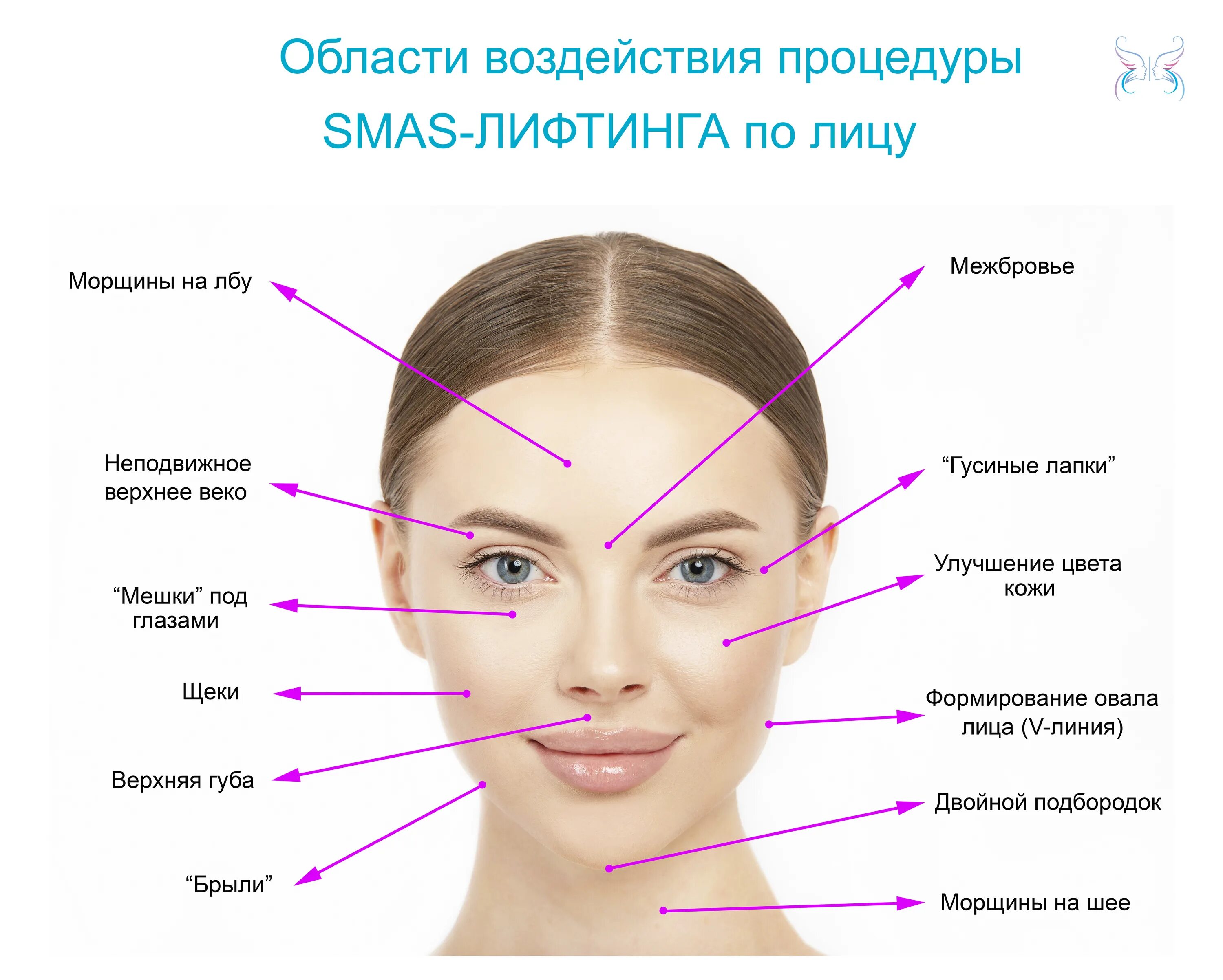 Лифтинг это простыми словами. Smas лифтинг схема линий на лице. Смас лифтинг линии на лице. Зоны лица для смас лифтинга. Схема смас лифтинг лица.