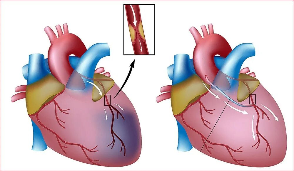 Операция на коронарные сосуды сердца. Аортокоронарное шунтирование схема операции. Коронарное шунтирование сосудов сердца. Аортокоронарное шунтирование (акш). Аорта коронарное шунтирование.