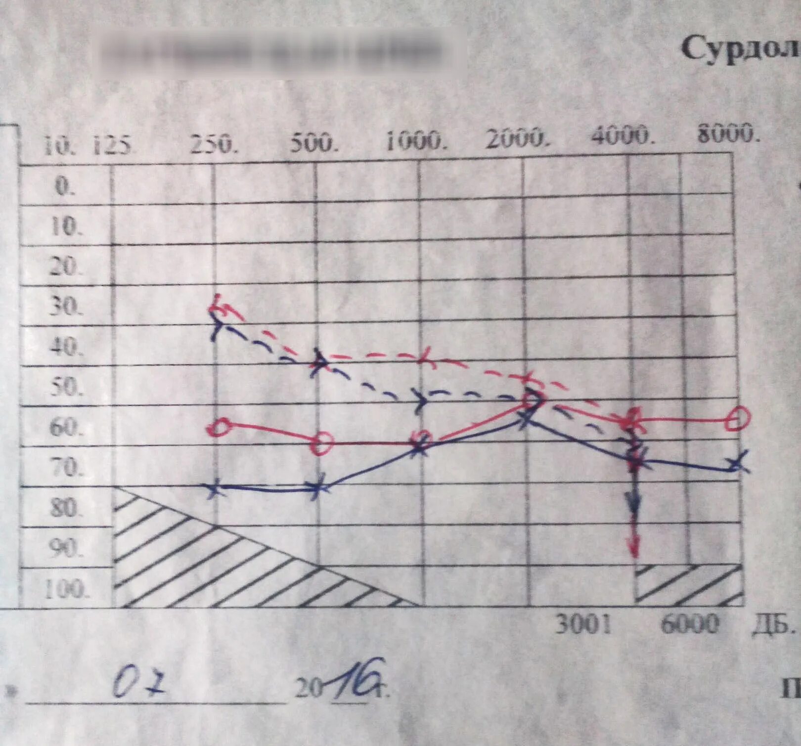 Международная классификация степеней тугоухости. Тугоухость 2 3. Двухсторонняя хроническая нейросенсорная тугоухость 1 ст. Кондуктивная тугоухость клиника. Двухсторонняя нейросенсорная тугоухость 3 степени.