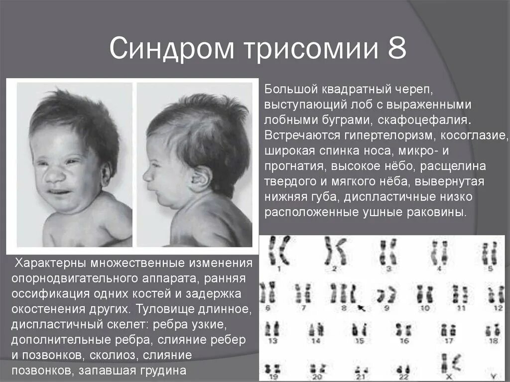 Появление дополнительной хромосомы. Синдром Эдвардса (трисомия по 18 паре хромосом). Хромосомные аномалии (синдром Патау, трисомия 13. Синдром Патау трисомия по 13 хромосоме. Синдром Дауна (трисомия по 21-Ой хромосоме);.