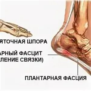 Почему появляется шпора причины. Подошвенный (плантарный) фасциит. пяточная шпора симптомы.