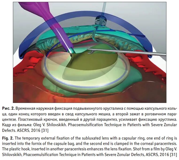 Капсульный мешок хрусталика. Крепление хрусталика глаза кольцом. Хрусталик ИОЛ В капсульном мешке.