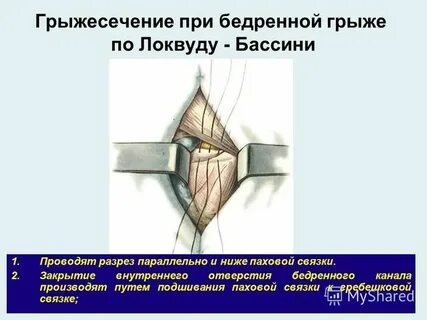 Грыжи грыжесечения