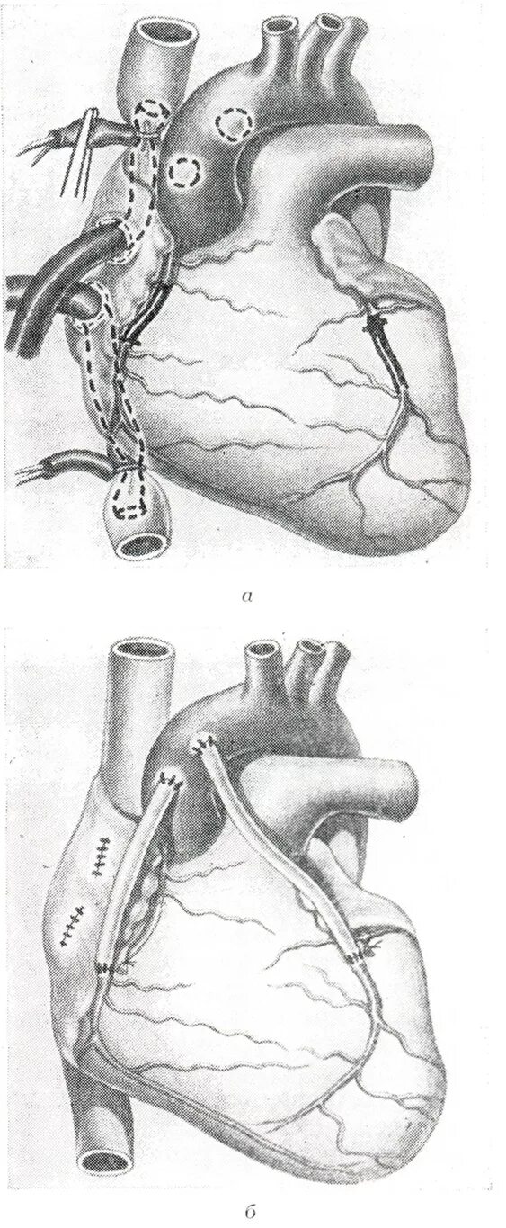 Операция шунтирование артерии. Аортокоронарное шунтирование инфаркт миокарда. Аорта коронарное шунтирование. Аортокоронарное шунтирование (АКШ). Аорта....аортокоронарное...шунтирование.