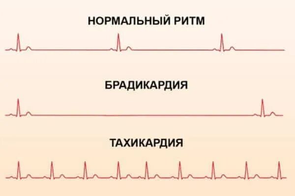 Нижний уровень пульса. Нормальный пульс брадикардия тахикардия. норма пульса тахикардия брадикардия. брадикардия норма тахикардия. нормальный сердечный ритм на экг.