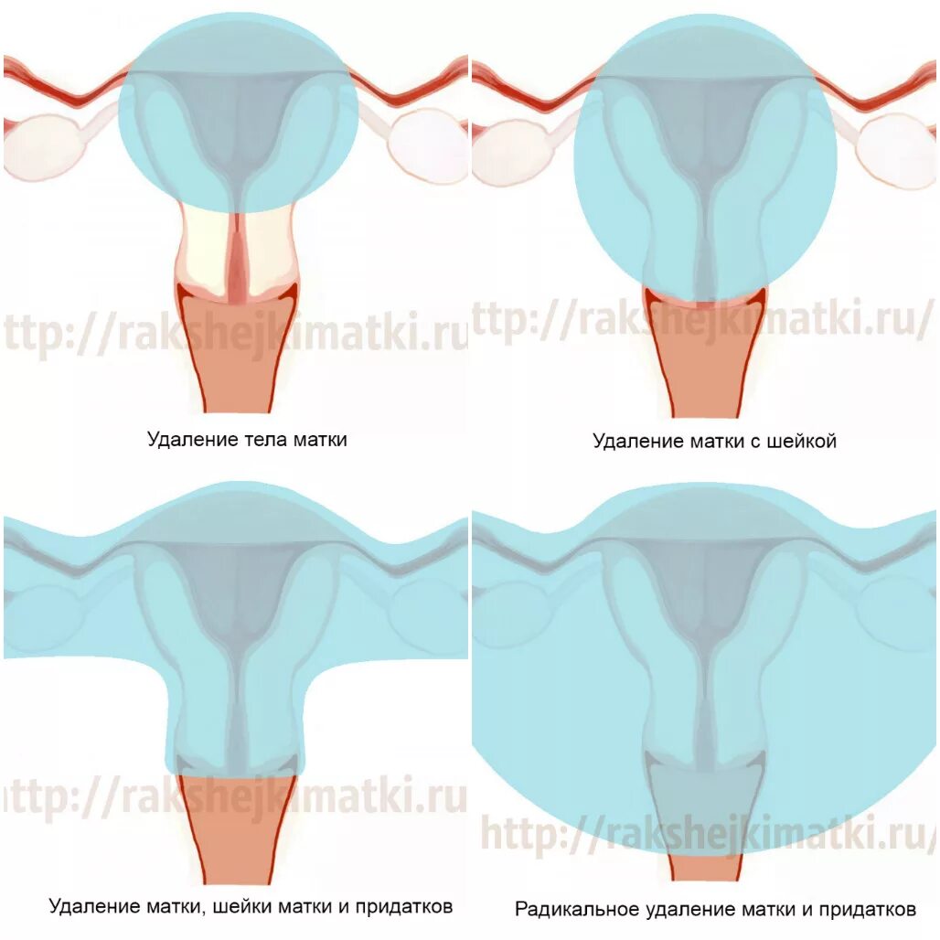 Тотальная экстирпация матки. Операция по удалению матки труб и шейки матки последствия. Экстирпация матки (тотальная гистерэктомия). Тотальная абдоминальная гистерэктомия. Тотальная матка