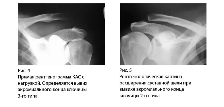 Дегенеративные изменения акромиально ключичного сустава. Подвывих акромиального конца ключицы рентген. разрыв акромиально-ключичного сочленения рентген. неполный вывих ключицы рентген. артроз грудино-ключичного сочленения рентген.