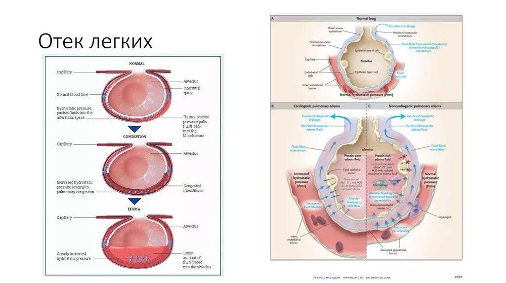 Механизм развития отека легких. Схема развития отека легких. Механизм развития отека легких схема. Отек легких схема. Отек легких механизм