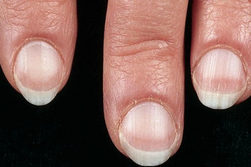 Почему ногти стали тоньше. Железодефицитная анемия койлонихия. Нормотрофический онихомикоз. Псориатическая ониходистрофия.