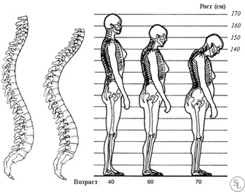 Возрастные изменения скелета. Позвоночник. Скелет позвоночника. Возрастные изменения позвоночника. Изгибы костей
