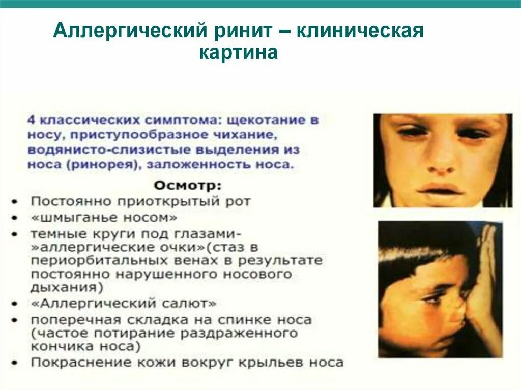 Симптомы насморка у взрослых. Клинические признаки аллергического ринита. аллергический ринит симптомы у детей. аллергический ринит проявления у детей. аллергический ринит в носу.