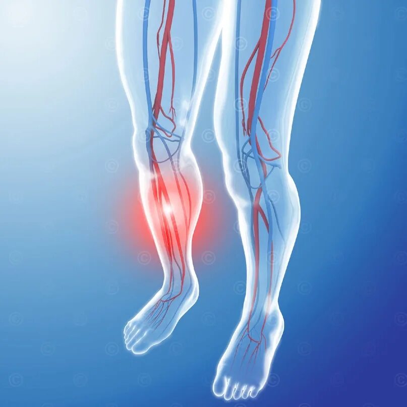 Застой крови у мужчин. Флеботромбоз голени клиника. Флебит тромбофлебит флеботромбоз.