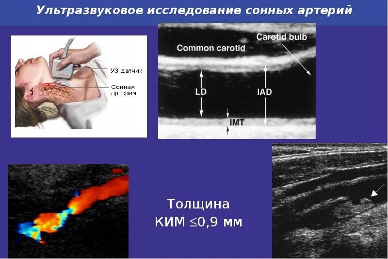 Толщина сонных артерий норма. Ультразвуковое исследование. ультразвуковое исследование сонных артерий. обследование сонной артерии. общая сонная артерия узи.
