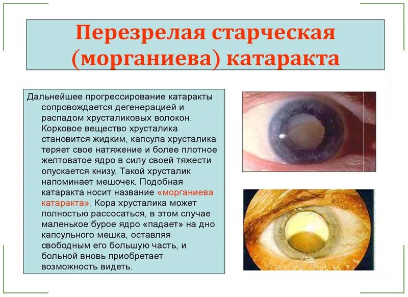 Катаракта глаза симптомы и лечение. Катаракта морганиева катаракта. сенильная катаракта стадии. возрастная катаракта помутнение хрусталика. стадии перезрелой катаракты.
