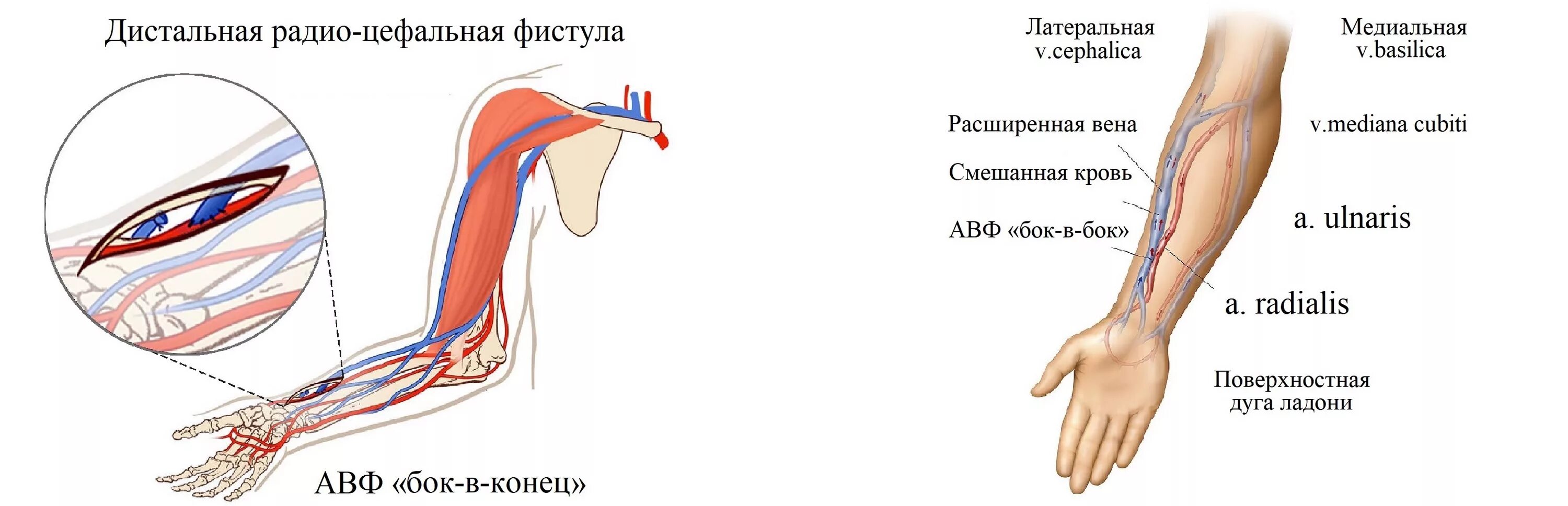 Фистула. Артерио-венозная фистула для гемодиализа. Протез фистулы для гемодиализа. Сосуды фистула для гемодиализа.