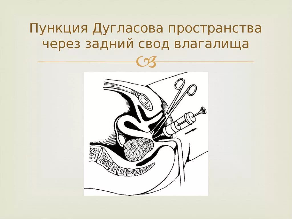 Задний свод матки. Диагностическая пункция дугласова пространства. Пункция дугласова пространства показания. Пункция абсцесса дугласова пространства. Прямокишечно-маточное (дугласово) пространство.