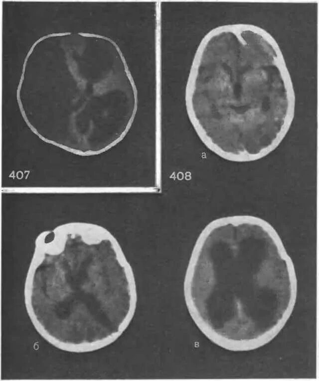 Окклюзионная гидроцефалия кт. Окклюзионная гидроцефалия мрт. Тетравентрикулярная гидроцефалия кт. Гидроцефалия расширение желудочков.