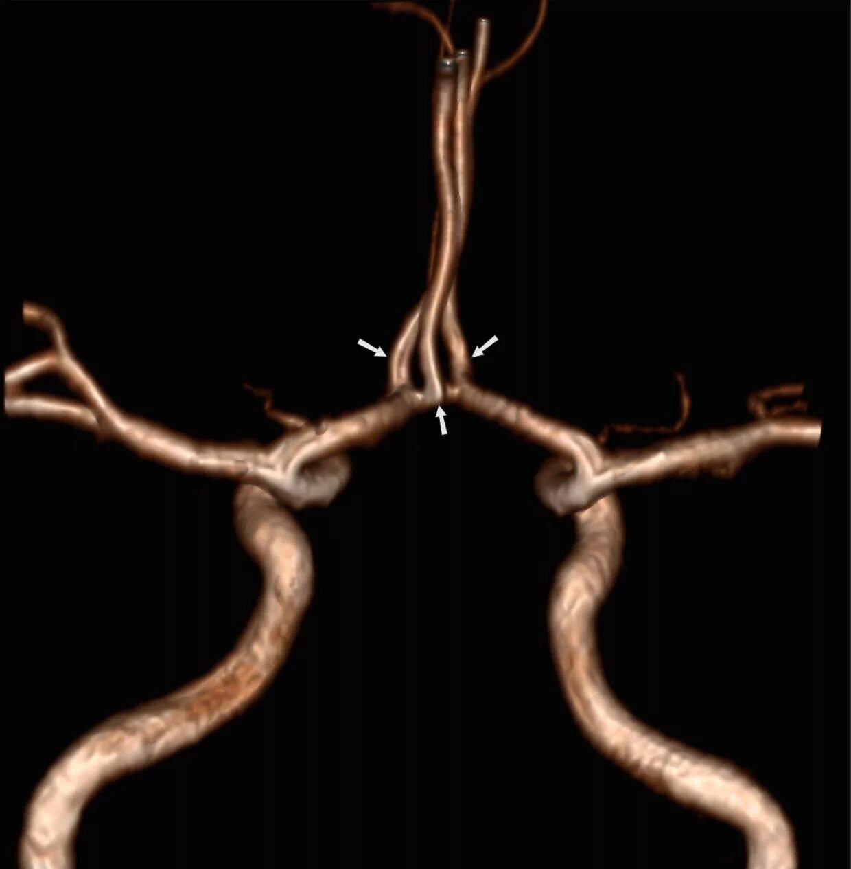 Гипоплазия правой артерии головного мозга. Задняя трифуркация правой внутренней сонной. Виллизиев круг трифуркация. Трифуркация внутренней сонной артерии. Передняя трифуркация правой передней внутренней сонной артерии.