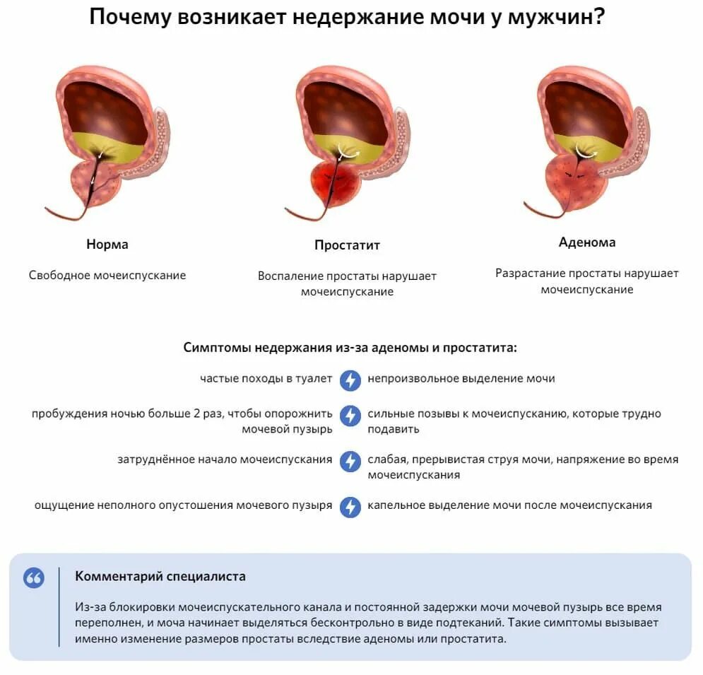 После операции предстательной железы недержание мочи. Уменьшение емкости мочевого пузыря. Проблемы с мочеиспусканием. Гиперплазия предстательной железы критерии.