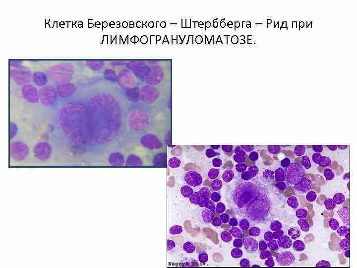 Клетки рида. Клетки Березовского-Штернберга гистология. Клетки Рида Березовского Штернберга гистология. Клетки Рид-Березовского-Штернберга и клетки Ходжкина.