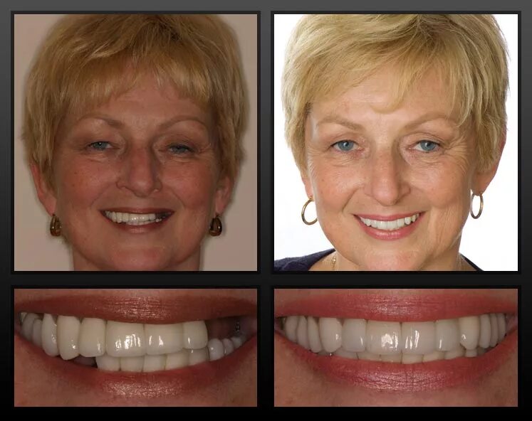 Снимать ли зубные протезы на ночь. Имплантация зубов до и после. Имплант зубов до и после. Зубы до и после имплантации. Имплантация передних зубов.