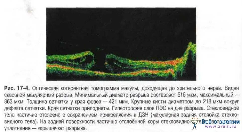 Оптическая когерентная томография (окт) диска зрительного нерва. Когерентная томография сетчатки глаза норма. Окт статьи. Слои сетчатки по окт. Окт статьи.