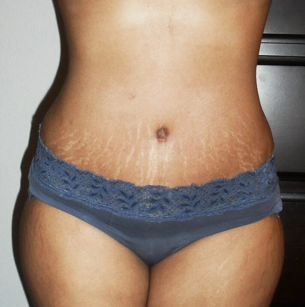 Растяжки stretch marks
