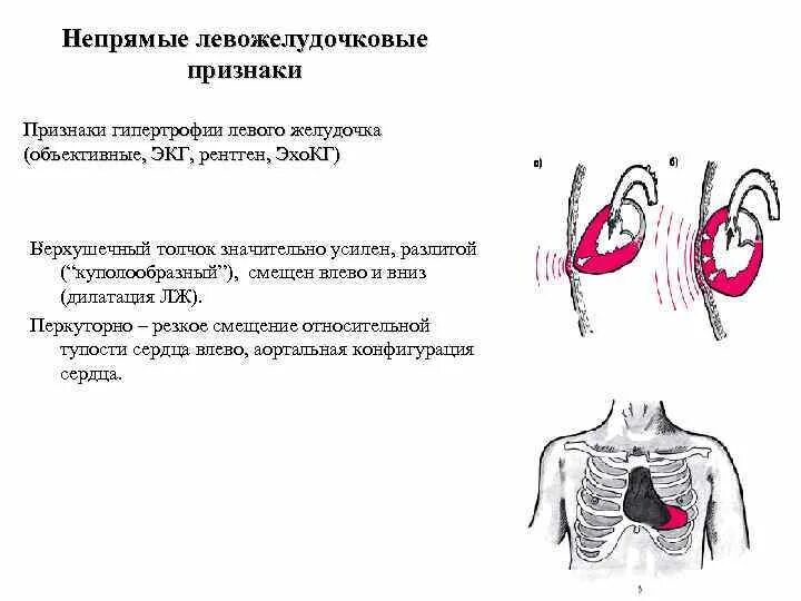 Верхушечный толчок при гипертрофии. Характеристика верхушечного толчка при гипертрофии левого желудочка. верхушечный толчок при гипертрофии сердца. верхушечный толчок при гипертрофии левого желудочка. левожелудочковый толчок при гипертрофии левого желудочка.