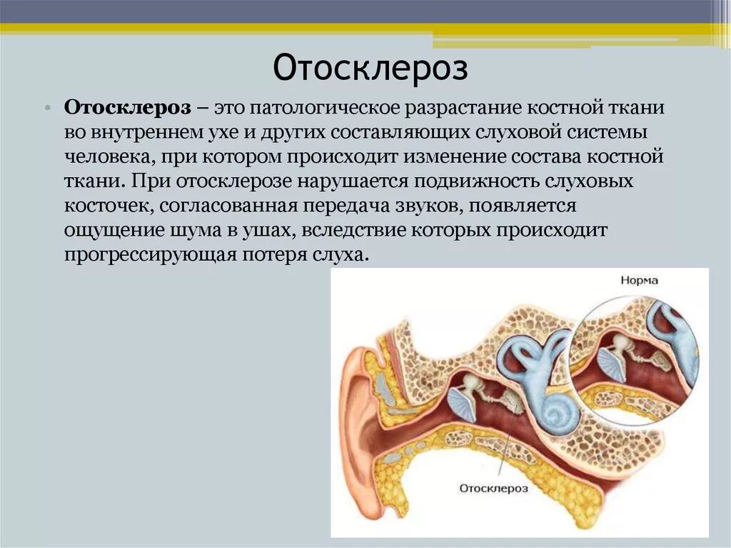 Почему воспаление среднего уха. Фенестральный отосклероз. Болезнь ушей отосклероз. Кондуктивный отосклероз. Отосклероз слухового прохода.