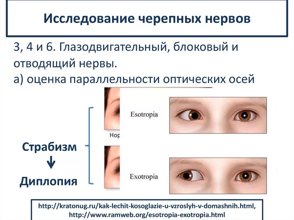 Парез отводящего. Методика исследования блокового нерва. методика исследования отводящего нерва. методы исследования поражения блокового нерва. исследование функции блокового нерва.