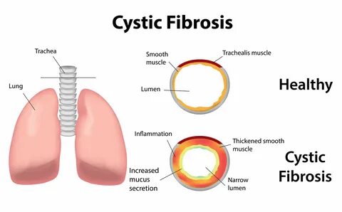 what causes cystic fibrosis - DriverLayer Search Engine.