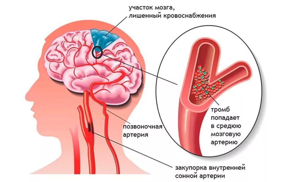 Что такое ишемический инсульт головного мозга. Ишемия ишемический инсульт мозга. ишемия мозга 2 степени у новорожденных. ишемический инсульт зоны поражения головного мозга. ишемический инсульт головного мозга клиника.
